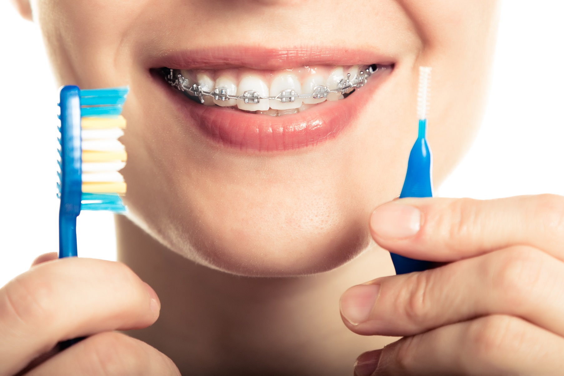 Can Braces Stain My Teeth? Bryan Hicks Orthodontics