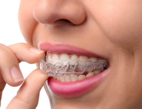 What is Open Bite? Can Invisalign Treat It?