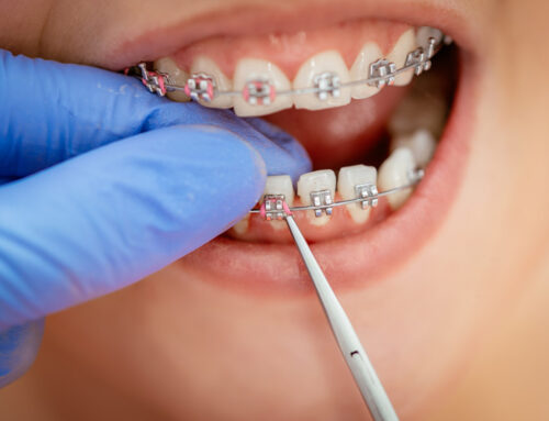 The Orthodontic Treatment Process – A Step-By-Step Guide